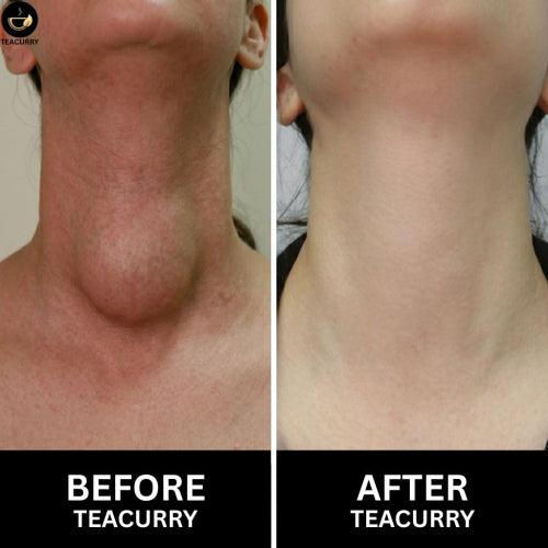 Teacurry Thyro Herb Tea - Women Before & After