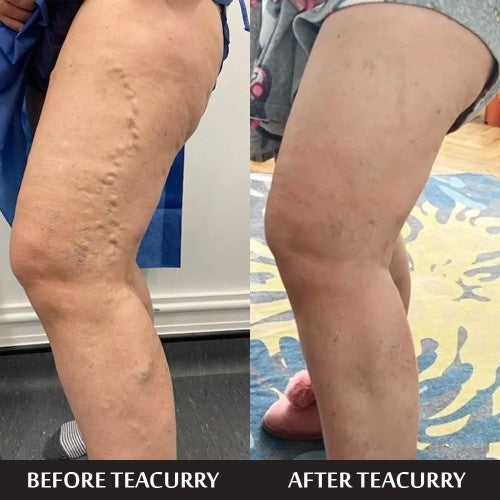 Teacurry Varicose Support Tea Before and After