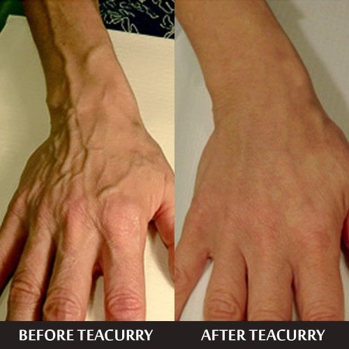 Teacurry Varicose Support Tea Before and After