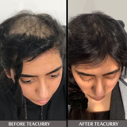 Teacurry Anti Bald Tea Before and After