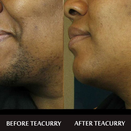Teacurry Facial Hair Removal Tea - before after