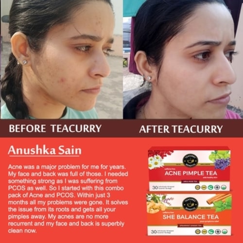 After before use of Acne pimple tea and she balance tea