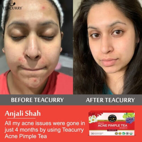 Acne pimple tea After before use image